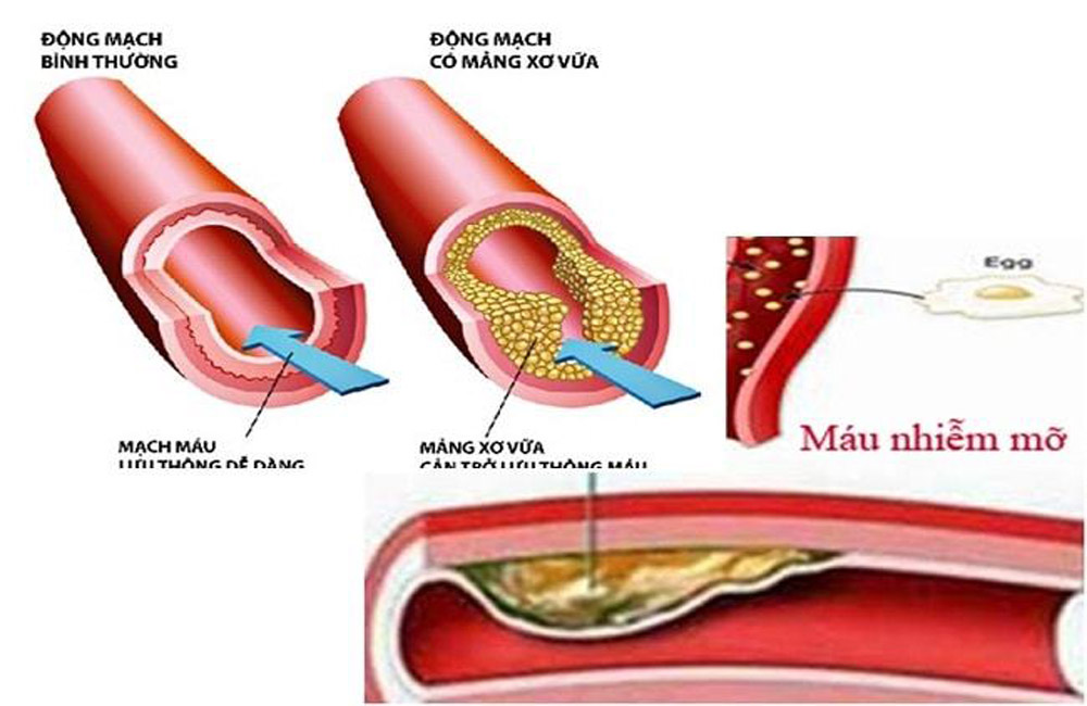 atheroscclerosis - Hình ảnh minh họa